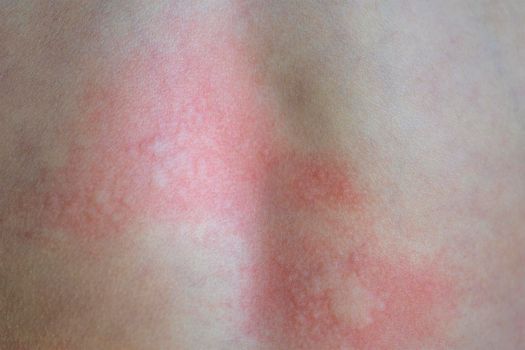 Urticaria on the skin. Red spots of an allergic reaction on the skin of a child. Urticaria symptoms close up.