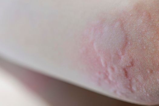 Urticaria on the skin. Red spots of an allergic reaction on the skin of a child. Urticaria symptoms close up.