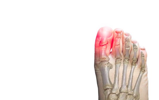 Close up of RIGHT Foot with bone show pain area isolated on a white background.