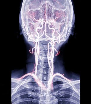 X-ray C-spine or x-ray image of Cervical spine AP view with cta carotid artery for diagnostic intervertebral disc herniation.