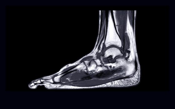 MRI FOOT Sagittal T2 for diagnostic tendon injury.