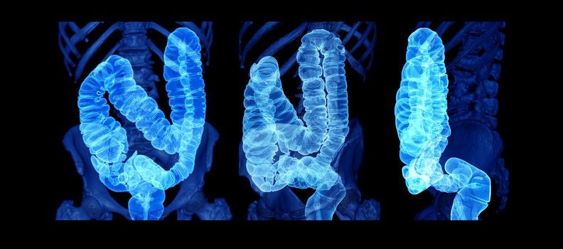 Collection of CT colonography or CT Scan of Colon 3D Rendering image showing colon for screening colorectal cancer. Check up Screening Colon Cancer.