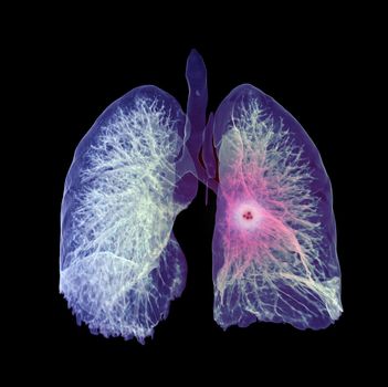 CT Chest or Lung 3D rendering image for diagnosis TB,tuberculosis and covid-19 .