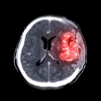 CT scan of the brain axial view post operative brain tumor.