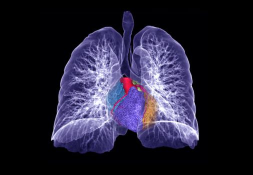 CT Chest or Lung 3D rendering image with 3D heart for diagnosis TB,tuberculosis and covid-19 .