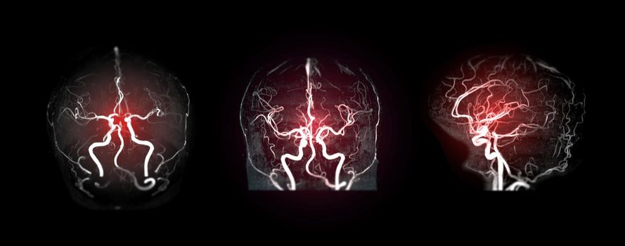 Collection of MRA brain or Magnetic resonance angiography image ( MRA ) of cerebral artery in the brain for detect stroke disease.