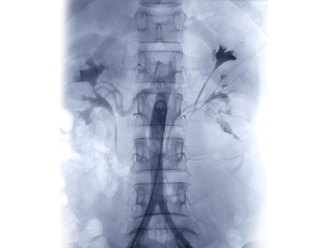 Selective Angiography for Renal Artery Diseases .