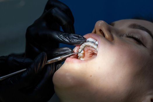 Installing a retainer after wearing braces. The process of removing braces.Beautiful woman in dental chair during procedure of installing braces to upper and lower teeth. Dentist and assistant working