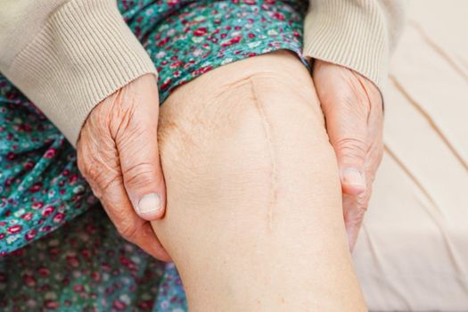 Asian elderly woman patient with scar knee replacement surgery in hospital.
