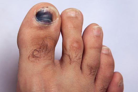 Closeup of a hairy human foot and toes with a cracked and black bruise toe nail on the largest toe on white background.