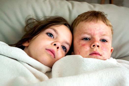 Natural vaccination between brother and sister. Contagious disease. Sick child with chickenpox. Varicella virus or Chickenpox bubble rash on child body and face. High quality photo