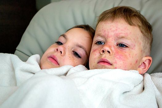 Natural vaccination between brother and sister. Contagious disease. Sick child with chickenpox. Varicella virus or Chickenpox bubble rash on child body and face. High quality photo