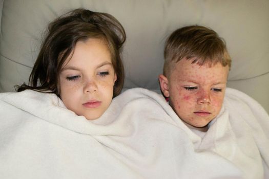 Natural vaccination between brother and sister. Contagious disease. Sick child with chickenpox. Varicella virus or Chickenpox bubble rash on child body and face. High quality photo