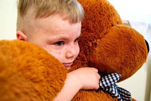 Natural vaccination. Contagious disease. Sick boy chickenpox with toy bear. Varicella virus or Chickenpox bubble rash on child body and face. High quality photo