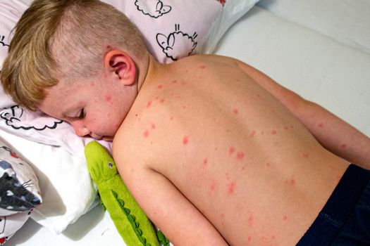 Natural vaccination. Contagious disease. Sick child with chickenpox. Varicella virus or Chickenpox bubble rash on child body and face. High quality photo