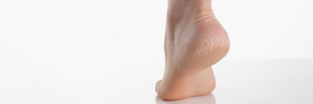 Close-up of single female leg or heel showing dried cracked heel with dried skin. Cracked womans heels during winter season. Wellness, self care concept