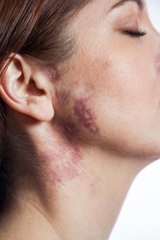 woman with real port wine stain birthmark on her face, isolated on white background.