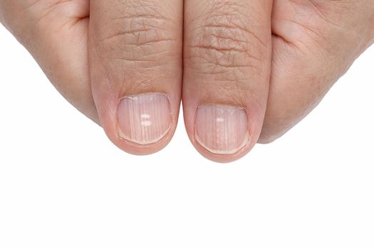 White spots and Vertical ridges on the fingernails symptoms deficiency vitamins and minerals