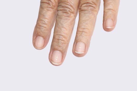 White spots on elderly fingernails caused by a calcium deficiency