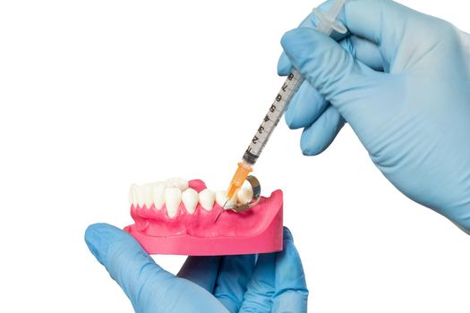 Dentist's hands holding a layout of the human jaw and a syringe with anesthetic on the white isolated background.
