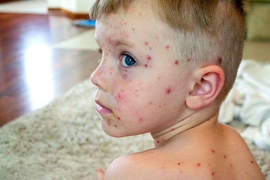 Natural vaccination. Contagious disease. Sick child with chickenpox. Varicella virus or Chickenpox bubble rash on child body and face. High quality photo