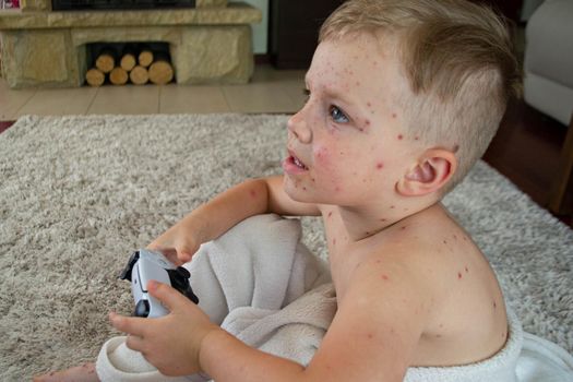 Natural vaccination. Contagious disease. Sick child with chickenpox. Varicella virus or Chickenpox bubble rash on child body and face. High quality photo