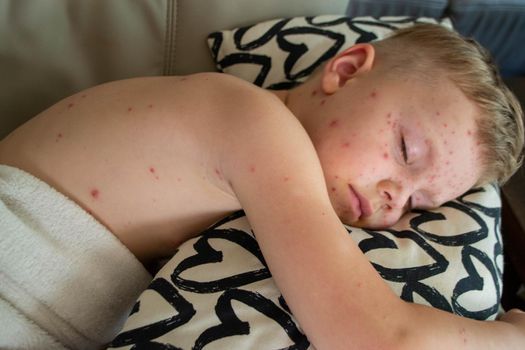 Natural vaccination. Contagious disease. Sick child with chickenpox. Varicella virus or Chickenpox bubble rash on child body and face. High quality photo