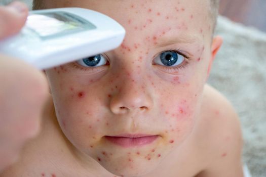 Natural vaccination. Contagious disease. Sick child with chickenpox. Varicella virus or Chickenpox bubble rash on child body and face. High quality photo