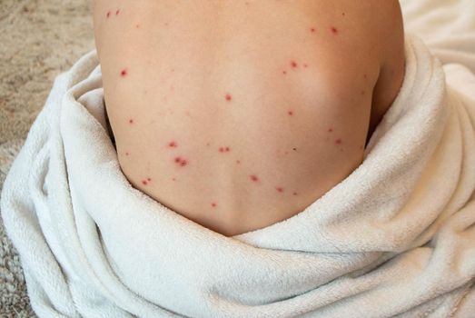 Natural vaccination. Contagious disease. Sick child with chickenpox. Varicella virus or Chickenpox bubble rash on child body and face. High quality photo