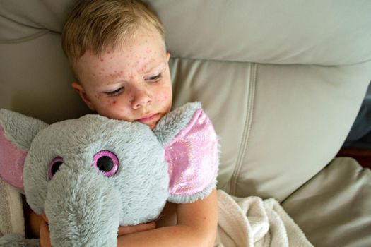 Natural vaccination. Contagious disease. Sick child with chickenpox. Varicella virus or Chickenpox bubble rash on child body and face. High quality photo