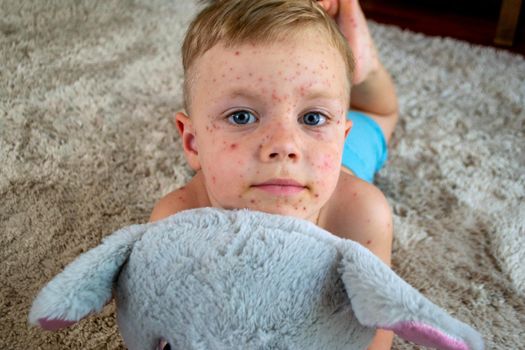 Natural vaccination. Contagious disease. Sick child with chickenpox. Varicella virus or Chickenpox bubble rash on child body and face. High quality photo