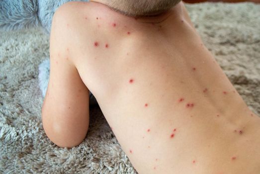 Natural vaccination. Contagious disease. Sick child with chickenpox. Varicella virus or Chickenpox bubble rash on child body and face. High quality photo