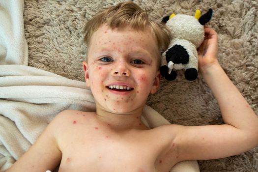 Natural vaccination. Contagious disease. Sick child with chickenpox. Varicella virus or Chickenpox bubble rash on child body and face. High quality photo