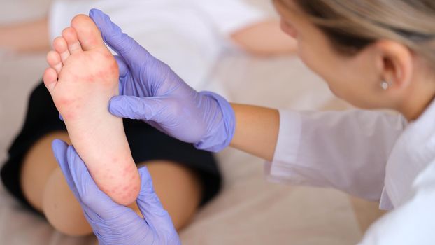 Doctor examining foot of child with red itchy rashes in clinic closeup. Enterovirus infection symptoms hand-foot-mouth concept