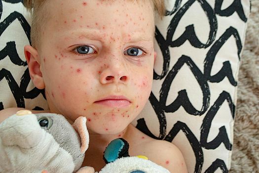 Natural vaccination. Contagious disease. Sick child with chickenpox. Varicella virus or Chickenpox bubble rash on child body and face. High quality photo