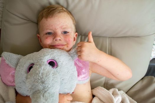 Natural vaccination. Contagious disease. Sick child with chickenpox. Varicella virus or Chickenpox bubble rash on child body and face. High quality photo