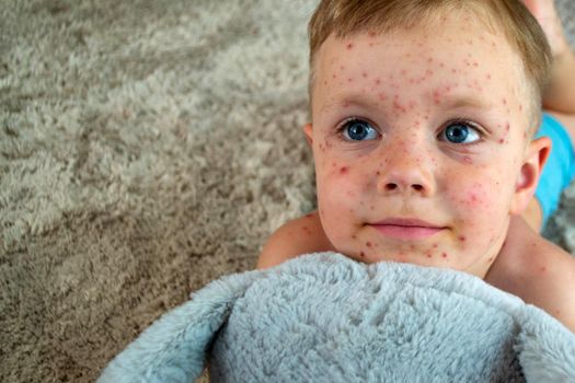 Natural vaccination. Contagious disease. Sick child with chickenpox. Varicella virus or Chickenpox bubble rash on child body and face. High quality photo