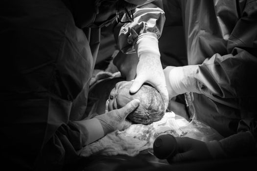 Cesarean section. The operation is in process. The child closeup