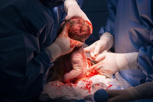 Cesarean section. The operation is in process. The child closeup