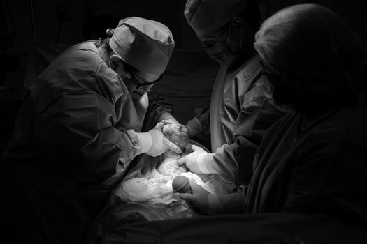 Cesarean section. The operation is in process. The child closeup