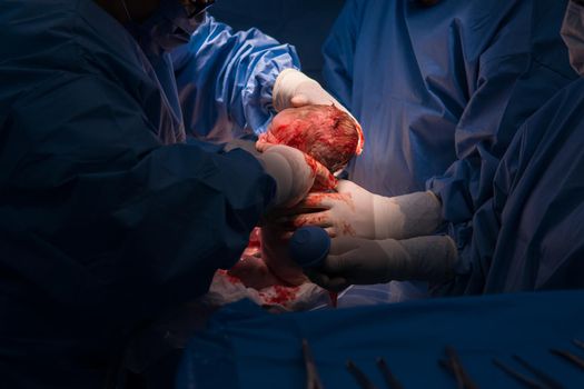 Cesarean section. The operation is in process. The child closeup