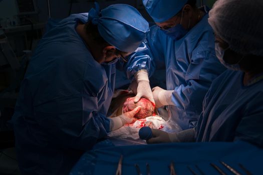 Cesarean section. The operation is in process. The child closeup