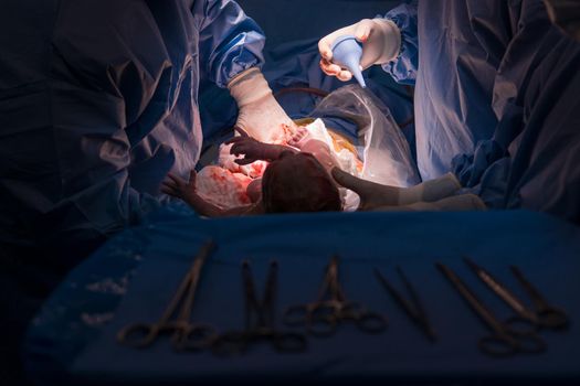 Cesarean section. The operation is in process. The child closeup