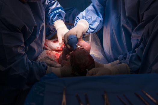 Cesarean section. The operation is in process. The child closeup