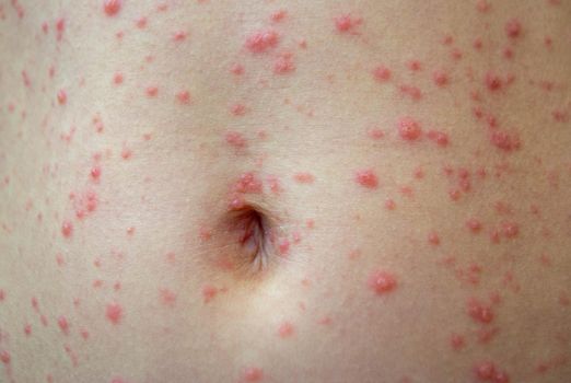 Natural vaccination. Contagious disease. Sick child with chickenpox. Varicella virus or Chickenpox bubble rash on child body and face. High quality photo