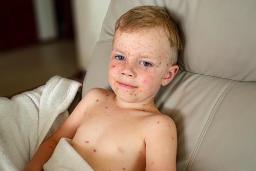 Natural vaccination. Contagious disease. Sick child with chickenpox. Varicella virus or Chickenpox bubble rash on child body and face. High quality photo