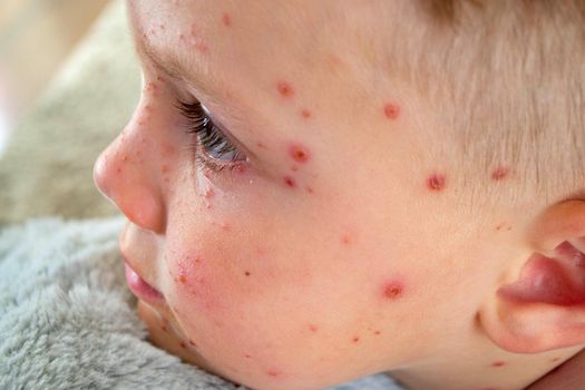 Natural vaccination. Contagious disease. Sick child with chickenpox. Varicella virus or Chickenpox bubble rash on child body and face. High quality photo