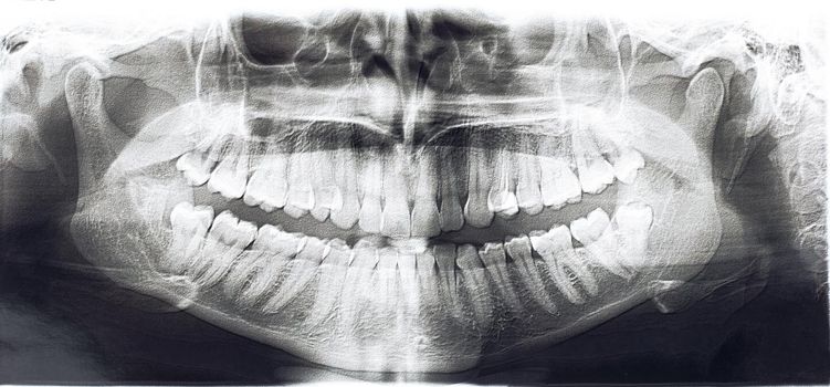 Panoramic x-ray of the jaw of the man close up