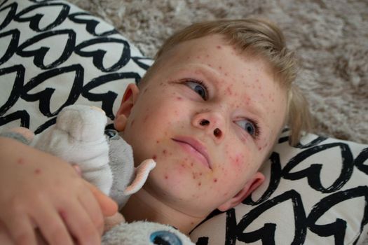 Natural vaccination. Contagious disease. Sick child with chickenpox. Varicella virus or Chickenpox bubble rash on child body and face. High quality photo