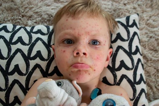 Natural vaccination. Contagious disease. Sick child with chickenpox. Varicella virus or Chickenpox bubble rash on child body and face. High quality photo